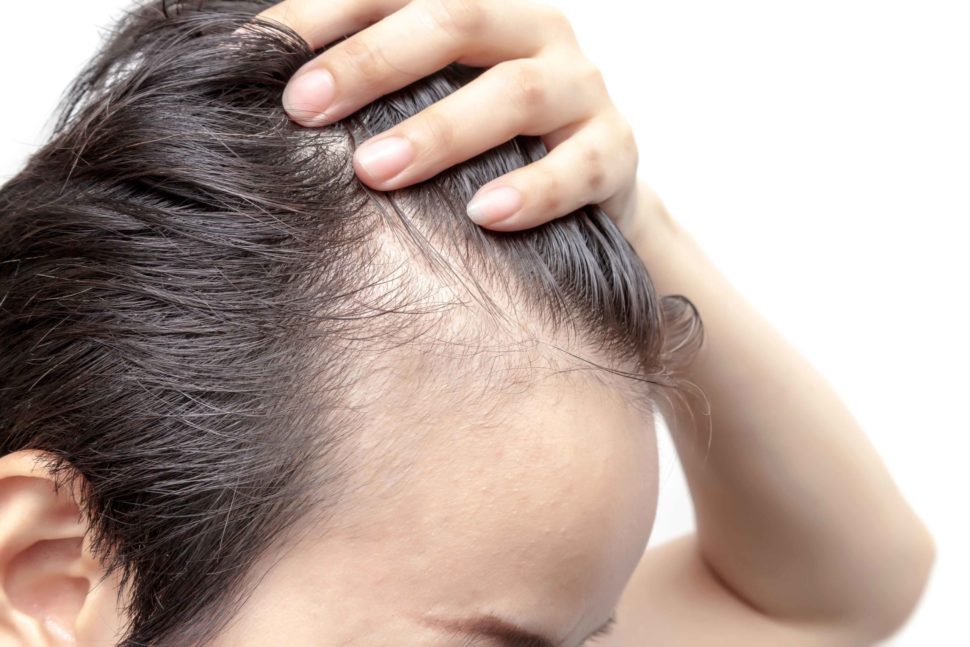 ¿Qué es la alopecia androgénica?