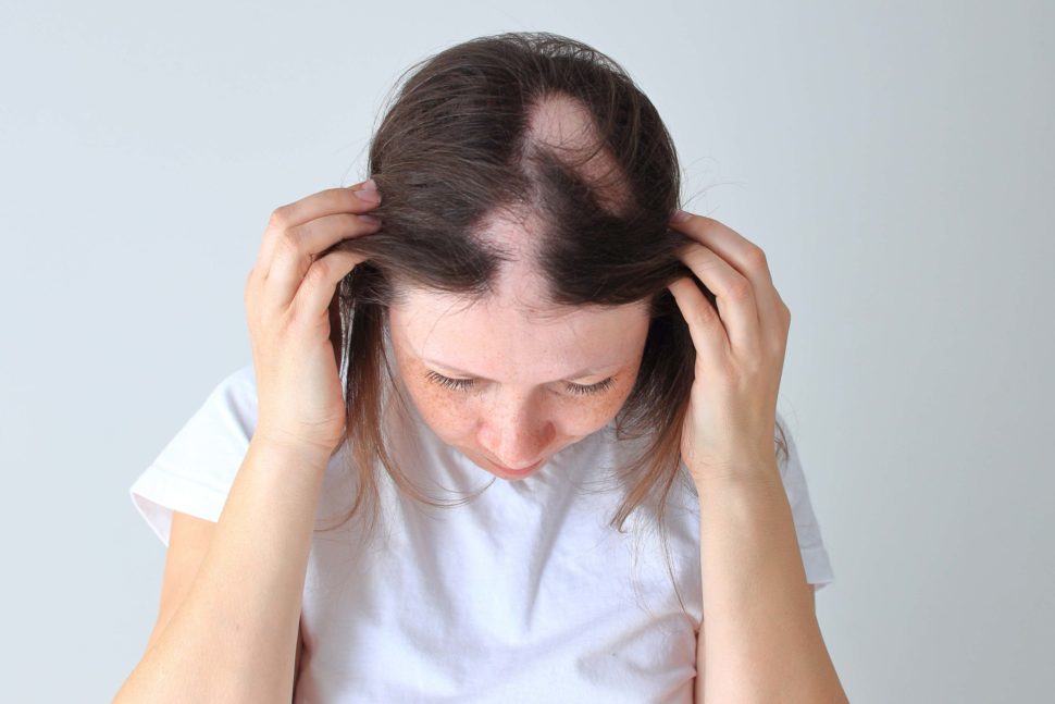 Tratamientos para la alopecia areata