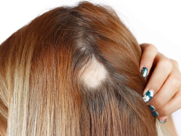 Tipos de alopecia cicatricial