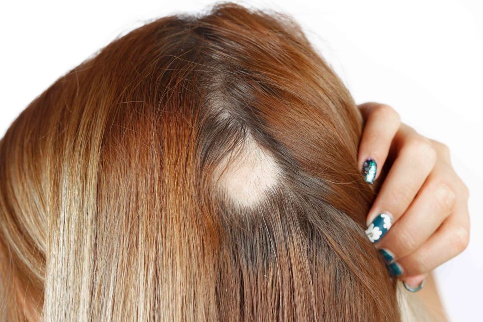 Tipos de alopecia cicatricial