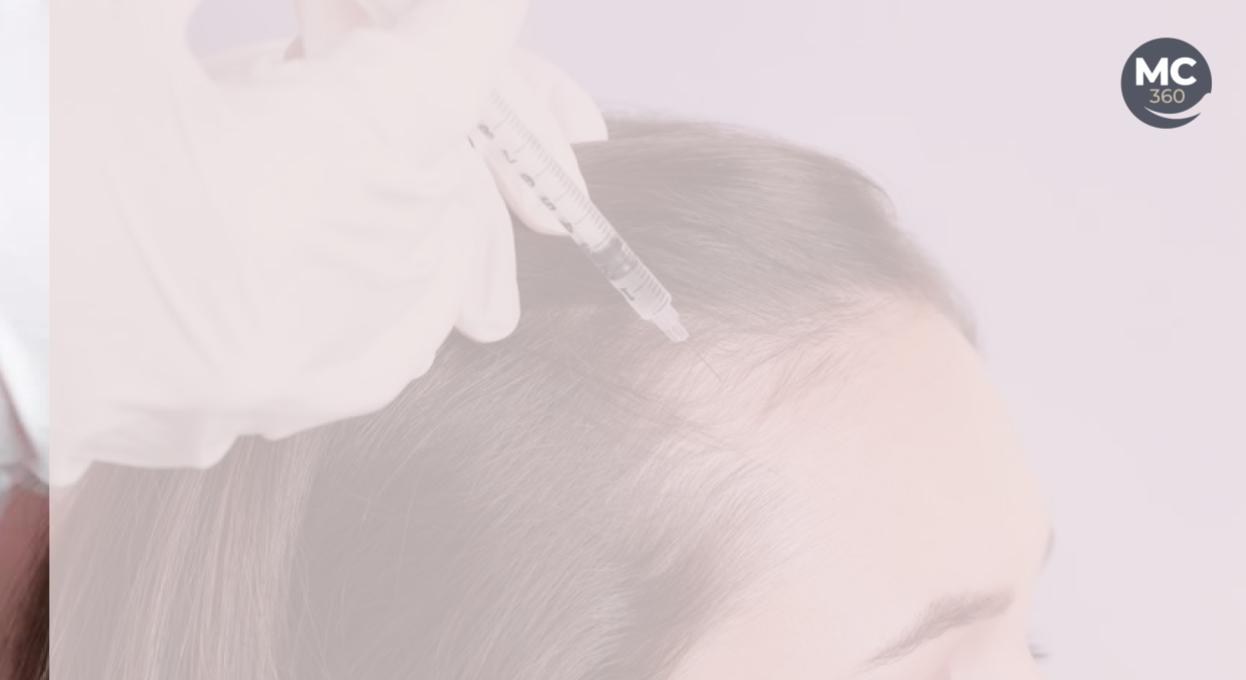 Alopecia femenina soluciones
