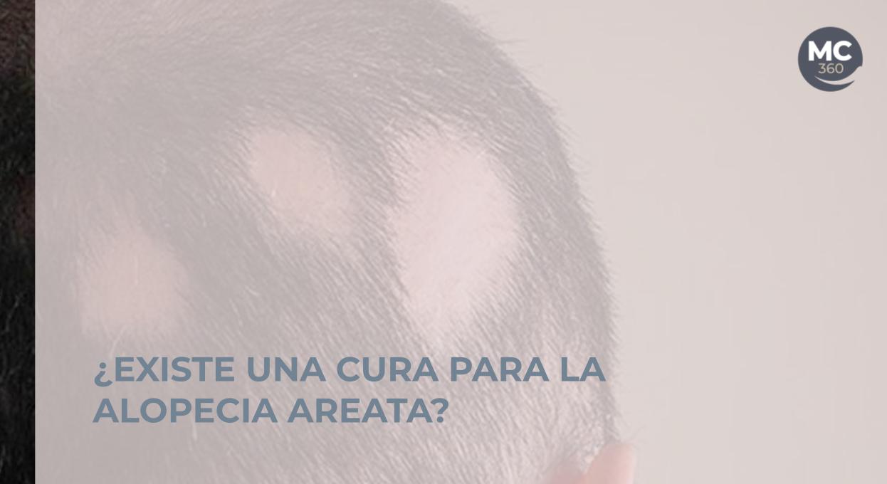 Cura alopecia areata