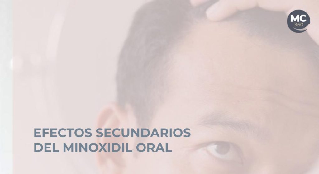 Efectos secundarios minoxidil oral