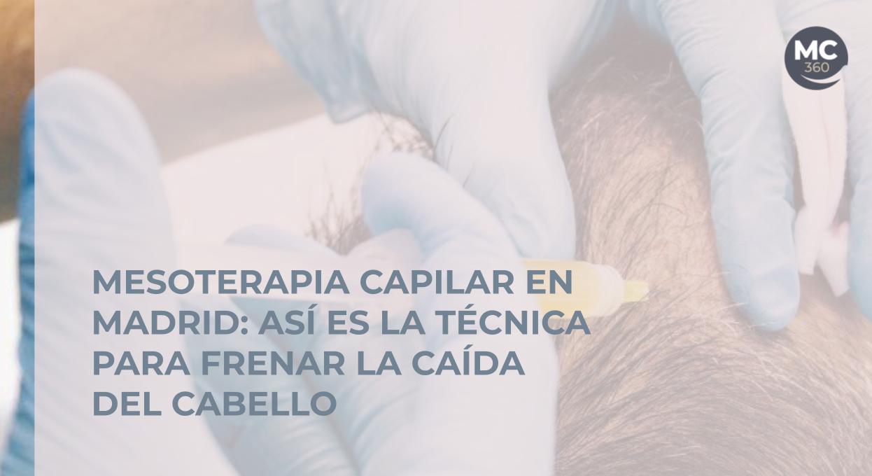 Mesoterapia capilar en Madrid