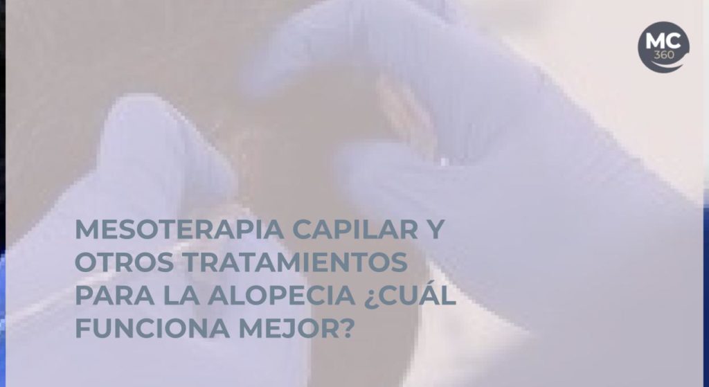 Mesoterapia capilar y otros tratamientos para la alopecia ¿Cuál funciona mejor?