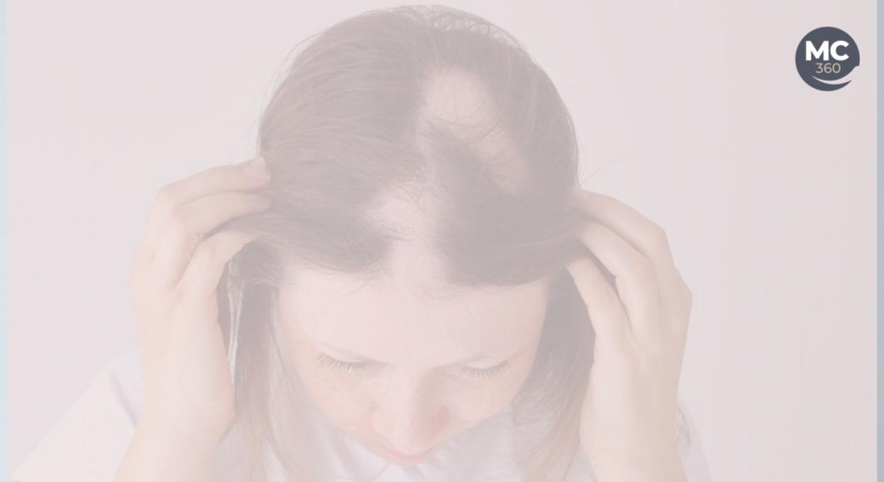 tratamiento alopecia areata